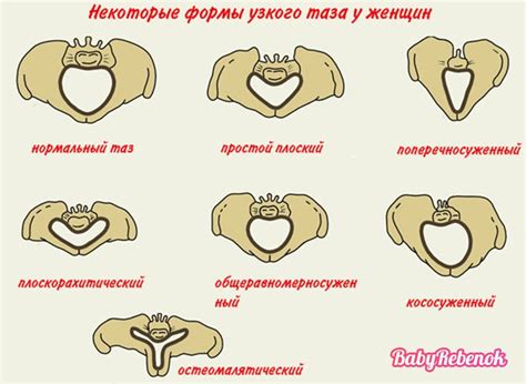 Существуют ли ограничения в раздвигании костей таза при родах?