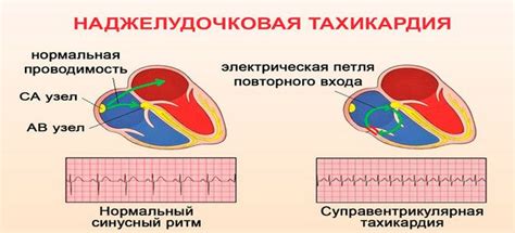 Тахикардия: причина одышки?