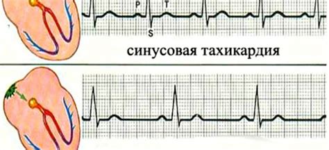 Тахикардия и физическая нагрузка: насколько опасно?