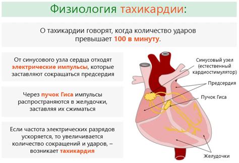 Тахикардия - что это такое?