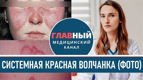 Типичные симптомы красной волчанки