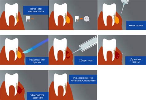 Традиционные методы лечения флюса на десне