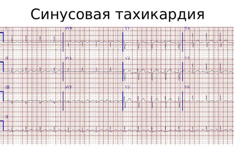 Трехпроекционное представление ЭКГ