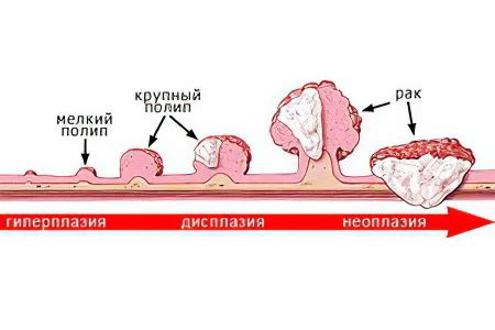 Удаление полипов в прямой кишке: необходимость и процедура