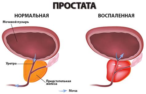 Улучшение функции простаты и снижение воспаления