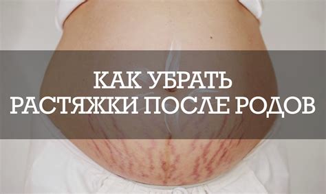 Уход за кожей живота после родов: как предотвратить и уменьшить растяжки