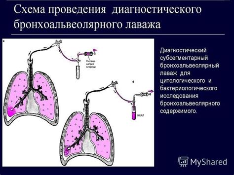 Фиброоптическая плевроскопия