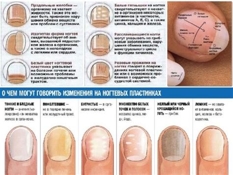 Физические изменения ногтей, свидетельствующие о заболеваниях