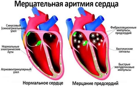 Характеристика мерцательной аритмии