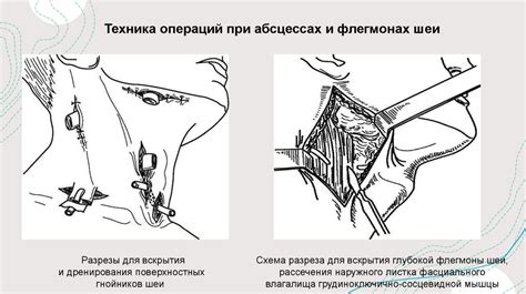 Хирургическое вмешательство при гнойных процессах в лимфоузлах