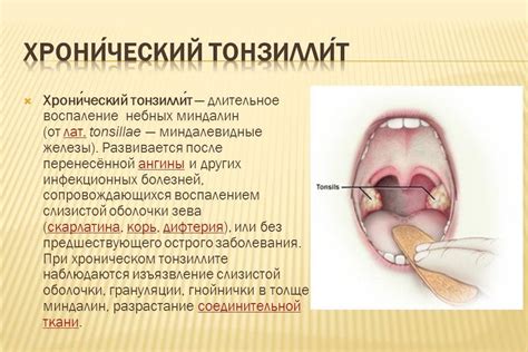 Хронический тонзиллит и его заразность