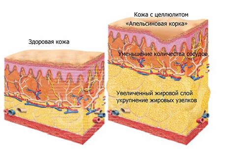 Целлюлит как комплексное явление и его связь с общим состоянием организма