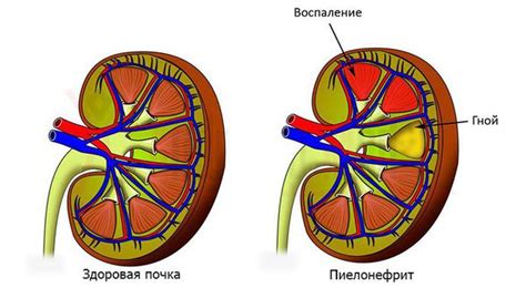 Что говорит симптоматика о застревании камня в мочеточнике?