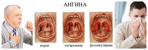 Что делать, если гланды начали расти после удаления?