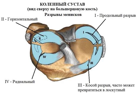 Что представляет собой разрыв мениска?