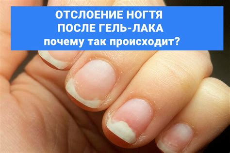 Что происходит после выдергивания ногтя?