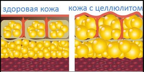 Что такое антицеллюлитный массаж?