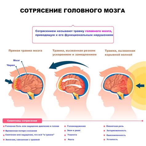 Что такое бессимптомное сотрясение мозга?