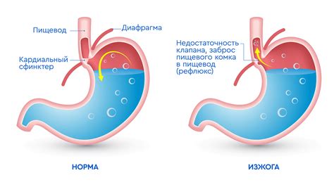 Что такое изжога