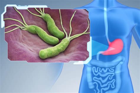 Что такое инфекция Helicobacter pylori?