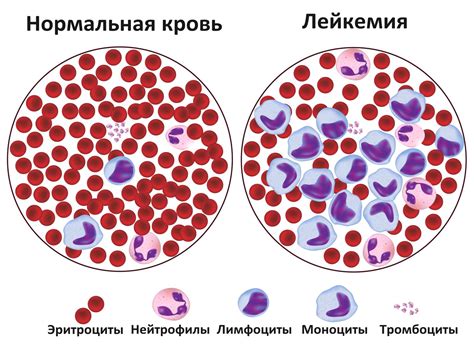 Что такое лейкемия