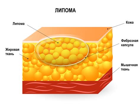 Что такое липома на ноге?