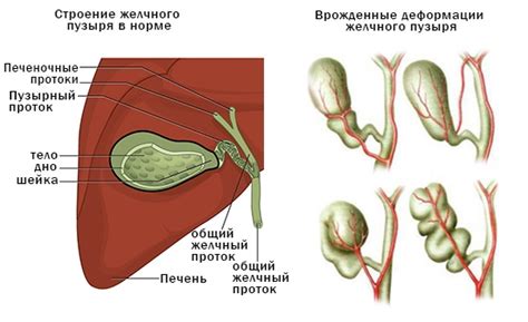 Что такое перегиб желчного пузыря?