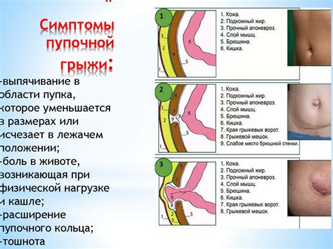 Что такое пупочная грыжа и как ее лечить?