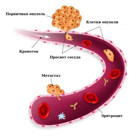 Что такое саркома матки?