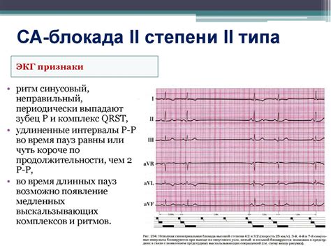 Что такое са блокада 2 степени 1 типа?