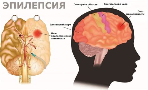 Что такое стресс и эпилепсия