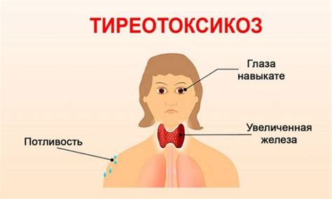 Что такое тиреотоксикоз?