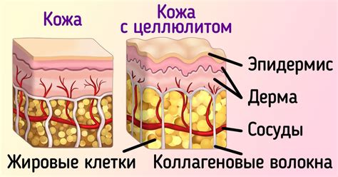 Что такое целлюлит и как он образуется?