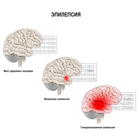 Эпилепсия: болезнь с потенциальными ограничениями