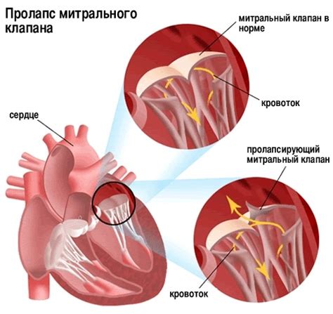 Эффективность препаратов при уменьшении пролапса митрального клапана