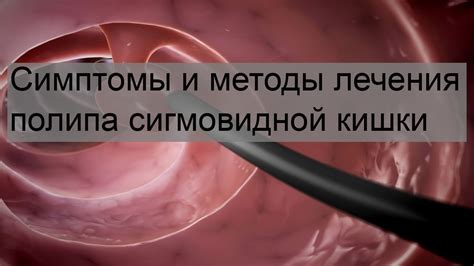 Эффективные методы лечения полипа