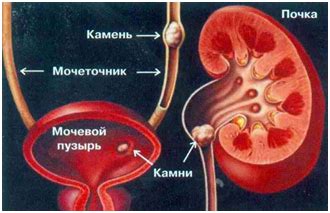  Влияет ли мочекаменная болезнь на появление тошноты? 