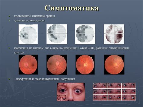  Существующие методы восстановления атрофии зрительного нерва 