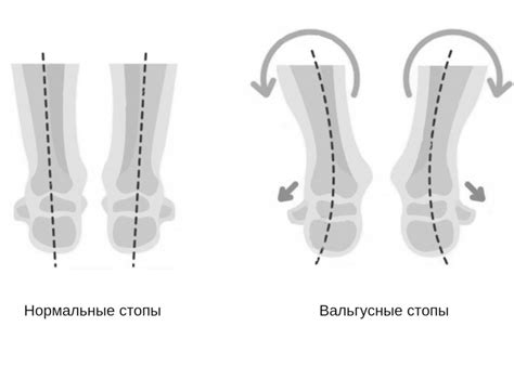  Что такое вальгусная деформация? 